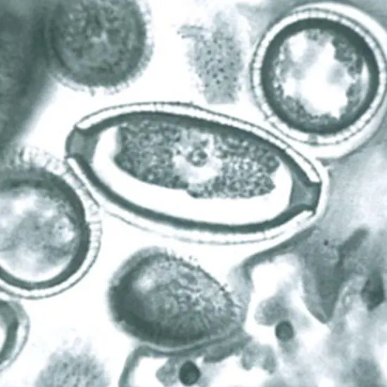 Intestinal Hepatic and Pulmonary Diseases A Triple Threat From Capillaria